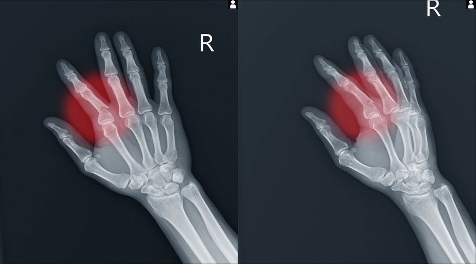 X-ray of Finger Injury in Fort Worth | Serious Injuries Attorney | Berenson Injury Law